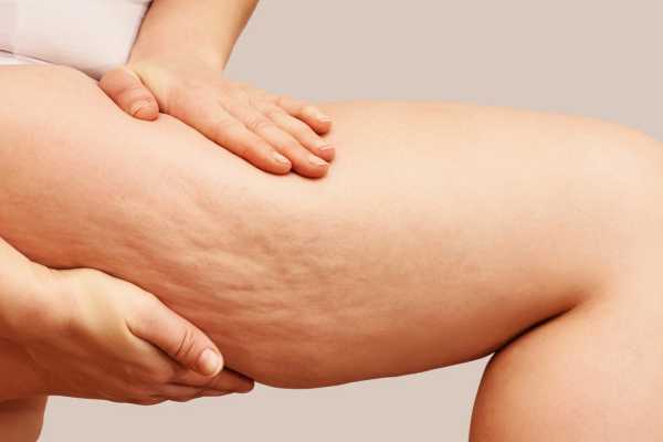 why cellulite treatment